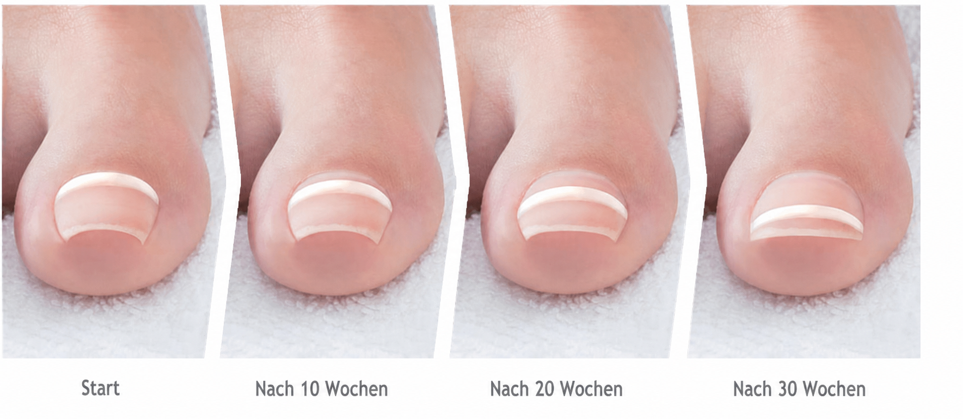 Behandlungsverlauf einer Onyfix®-Nagelkorrektur: Start, nach 10 Wochen, nach 20 Wochen und nach 30 Wochen – der Nagel wächst zunehmend flach heraus.